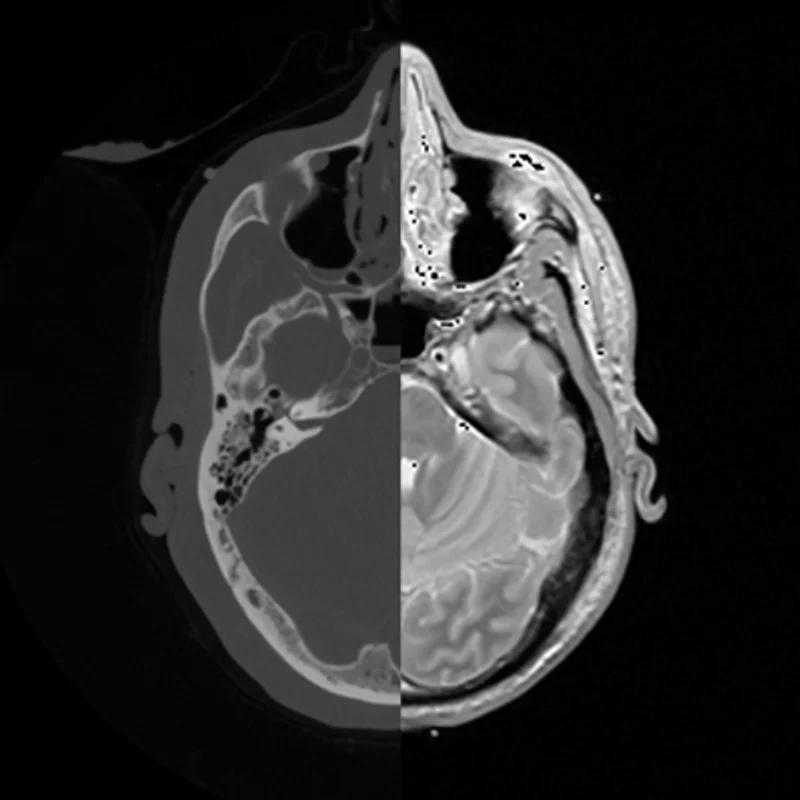 CT BRAIN