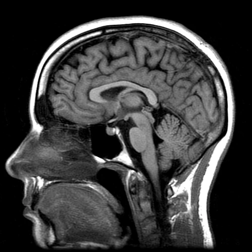 MRI BRAIN